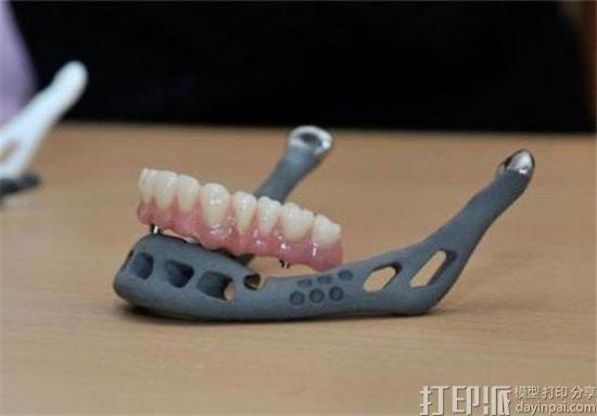 3D打印种植牙手术导板具备哪些优点？