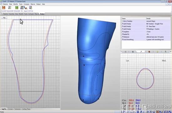 Create O&P引入Canfit设计软件 允许诊所医生定制医疗器械 Create O&P引入Canfit设计软件 允许诊所医生定制医疗器械