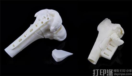 Materialise公司用于儿科截骨术的3D打印手术导板获得FDA的生产许可