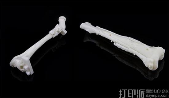 Materialise公司用于儿科截骨术的3D打印手术导板获得FDA的生产许可
