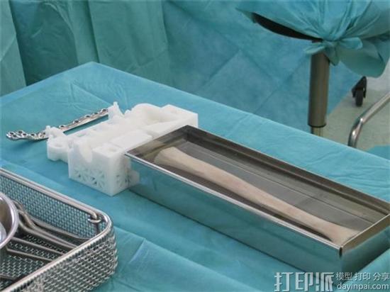 Materialise公司用于儿科截骨术的3D打印手术导板获得FDA的生产许可