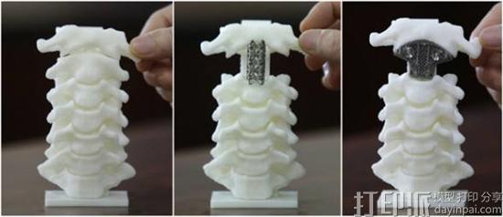 3D打印如何助力精准医疗？