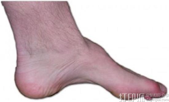 Cedars-Sinai团队使用3D打印脚跟模型证明现行的脚后跟畸形手术需要改进