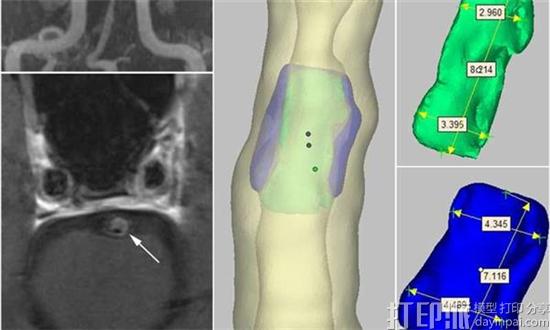 美国两大学联合开发出将血管壁MRI扫描标准化的颅内动脉3D打印模型