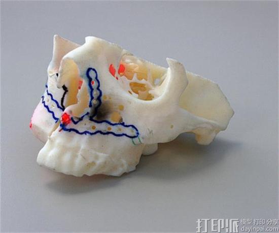 英国医院借Stratasys的3D打印技术实现每次手术节省20000英镑