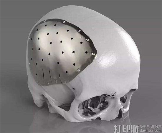 3D打印是怎么帮助医生做面部重建手术的？