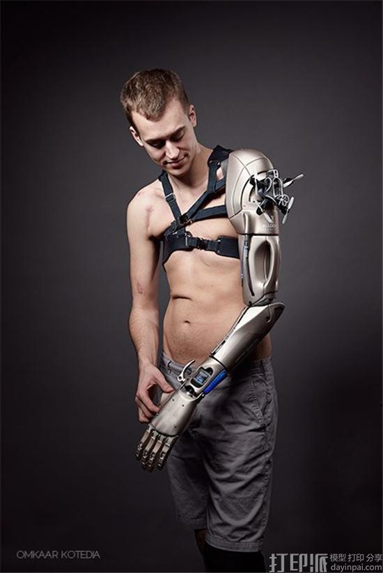 Open Bionics公司参加世界第一个3D打印仿生手的临床试验