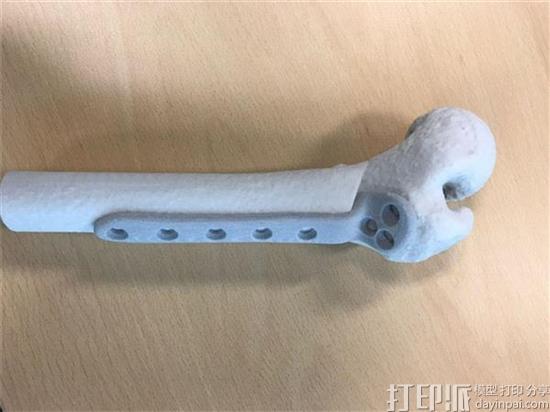 阿姆斯特丹医院成功为患者植入荷兰首个3D打印植入物