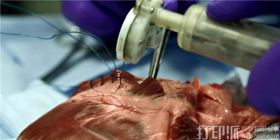 英国心胸外科医生借助3D打印机创建医疗器械