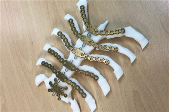 荷兰医院使用3D打印模型帮助减少胸骨固定手术的时间