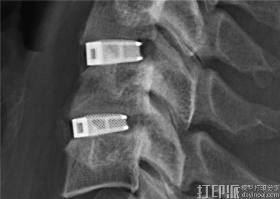 EIT公司的3D打印CellularTitanium®椎间融合器获FDA批准