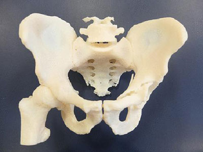 西安仲德骨科医院“3D打印人工右侧全髋关节置换术”顺利完成