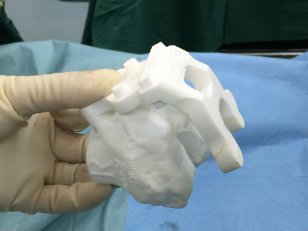 专家深度解析：髋膝关节翻修术中的关键问题及3D打印应对之策