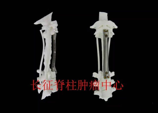 全球首例！上海长征医院成功为患者植入15厘米长3D打印钛金属椎体