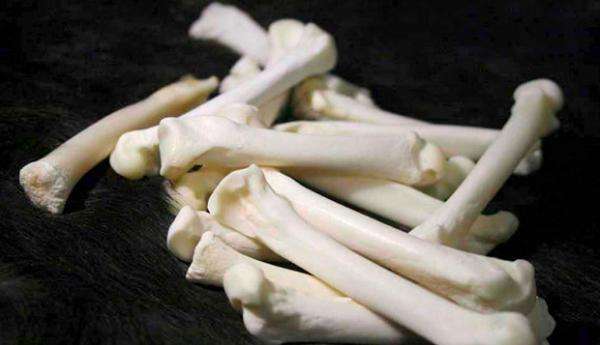 人体骨关节坏了 汕头二医院“3D打印”做新的