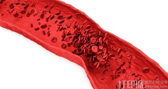 研究团队用3D打印微流体血管模型调查动脉血栓的形成原因