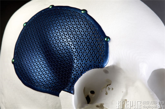 巴黎知名整形医生Lantieri认为3D打印在为整形手术带来革命性的进步