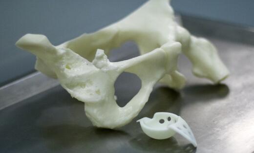湖南医药学院第一附属医院3D打印完成人工全髋关节翻修术