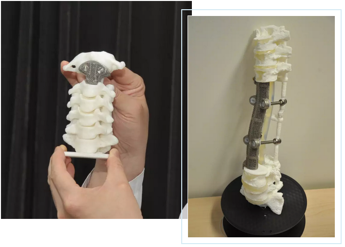 北大第三医院刘忠军：3D打印钛合金骨骼挺起中国人的脊梁