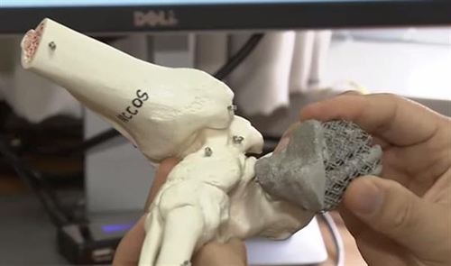 南京市第一医院成功完成一例3D打印辅助微创足跟骨手术