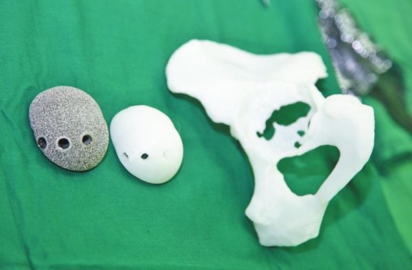 襄阳市中心医院成功完成首例3D打印髋关节翻修术
