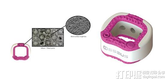 Osseus的新型3D打印颈部植入物获得FDA批准 Osseus的新型3D打印颈部植入物获得FDA批准