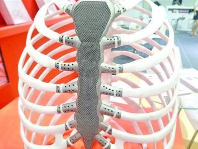 患者的重大福利！3D打印胸骨可以做到完全复原