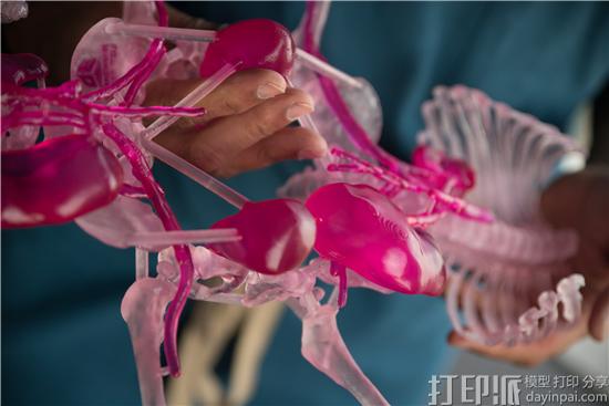 3DSystems的3D打印模型成功帮助医生实施连体婴分离手术