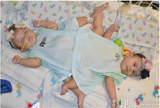 3DSystems的3D打印模型成功帮助医生实施连体婴分离手术