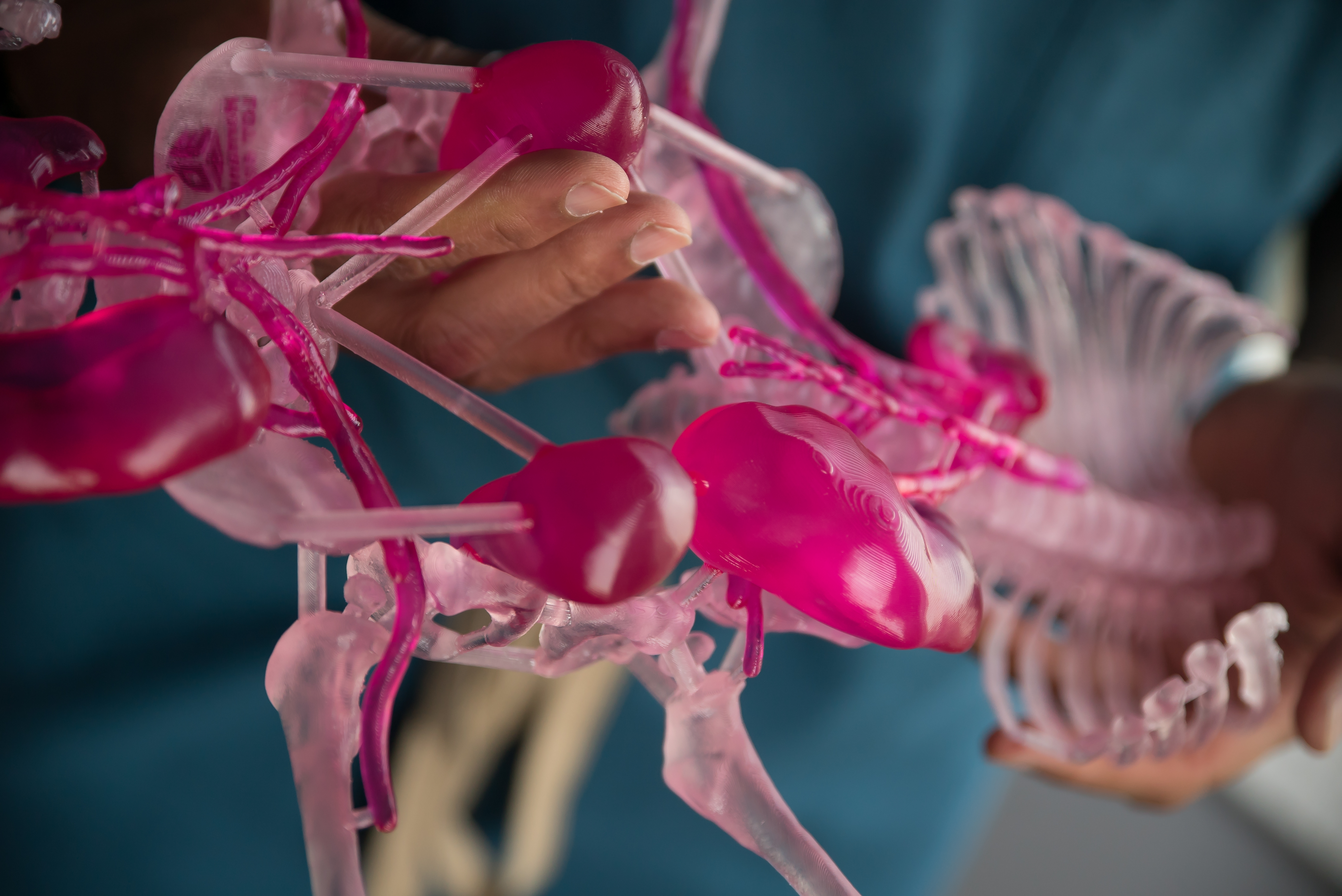 3DSystems的3D打印模型成功帮助医生实施连体婴分离手术