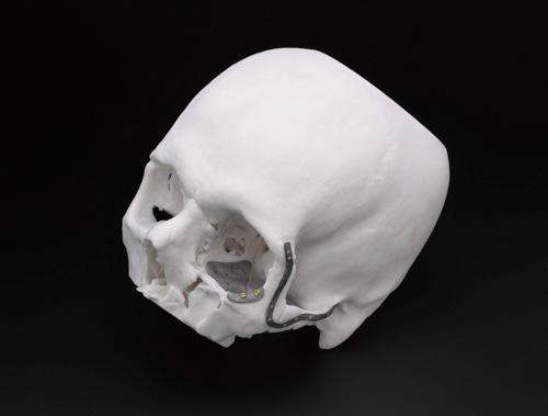 郑州市中心医院成功运用3D打印技术救治高处坠落患者