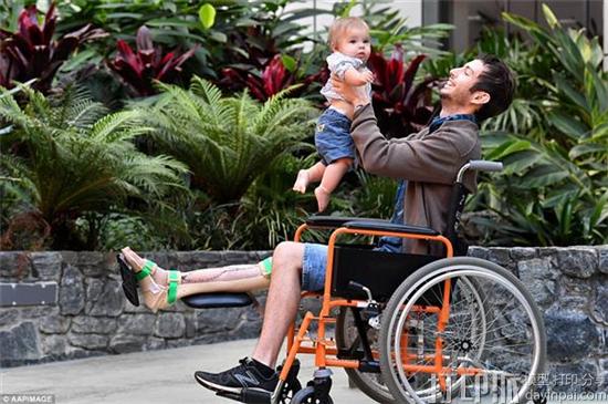 医院为澳洲小伙植入了3D打印胫骨支架 助其逃脱截肢厄运