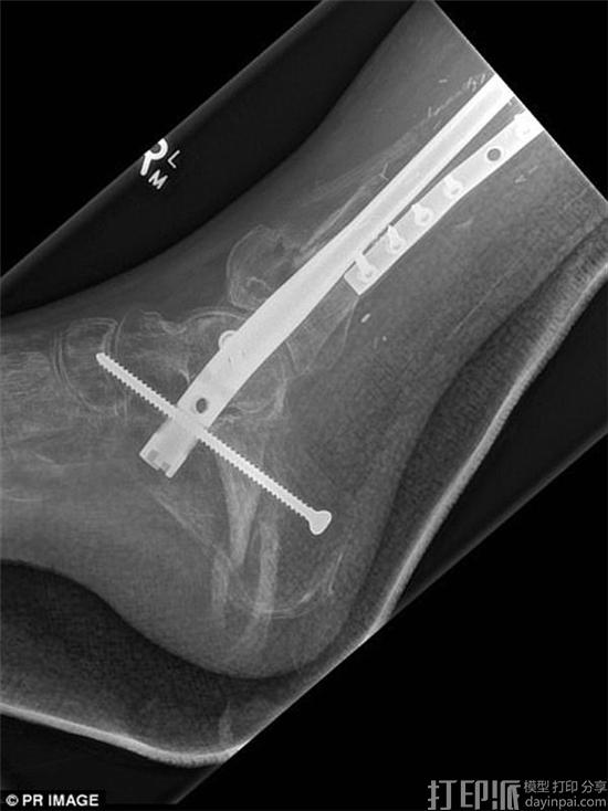 医院为澳洲小伙植入了3D打印胫骨支架 助其逃脱截肢厄运