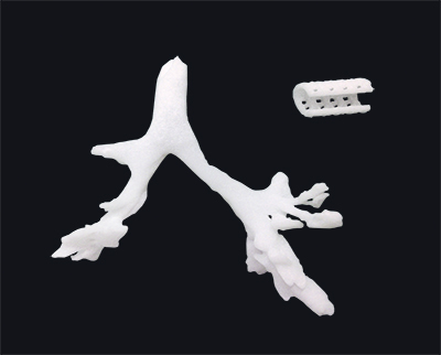 辽宁营口市一支气管狭窄患者获3D打印技术救治