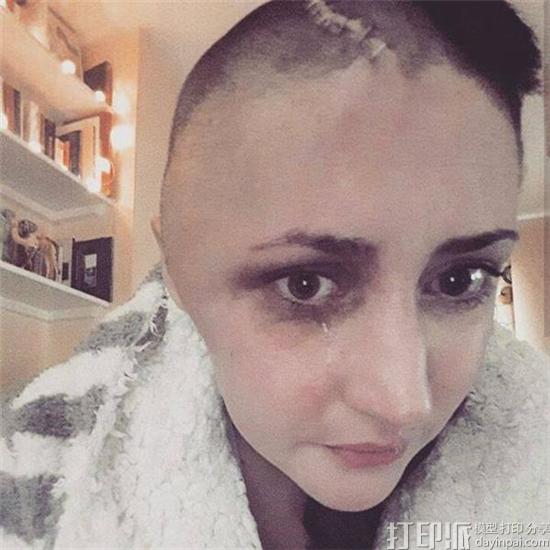 英国女模特摔下楼梯致颅骨缺一半 医生使用3D打印为其重建头骨