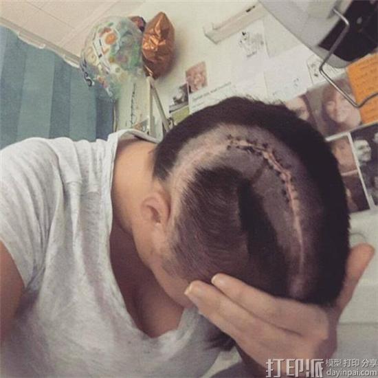 英国女模特摔下楼梯致颅骨缺一半 医生使用3D打印为其重建头骨