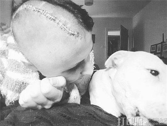 英国女模特摔下楼梯致颅骨缺一半 医生使用3D打印为其重建头骨