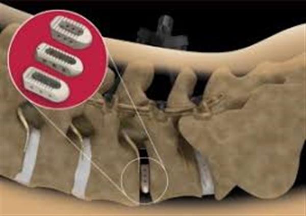 Stryker公司的3D打印钛金属脊柱装置获得FDA批准