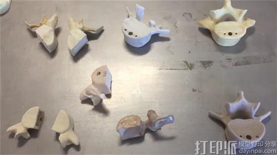 3D打印椎骨帮助英国诺丁汉脊柱外科医生进行精确的手术演练