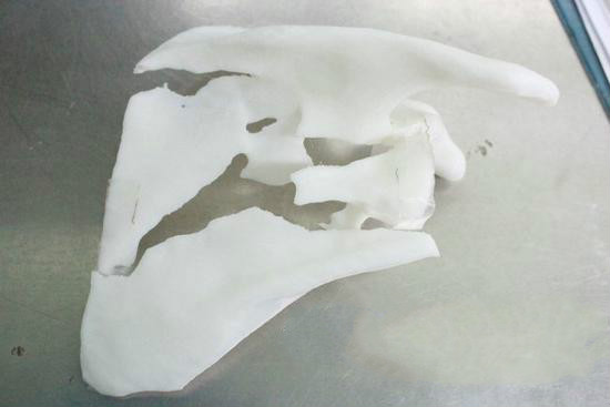 胶州市首次将3D打印技术应用到骨折临床治疗