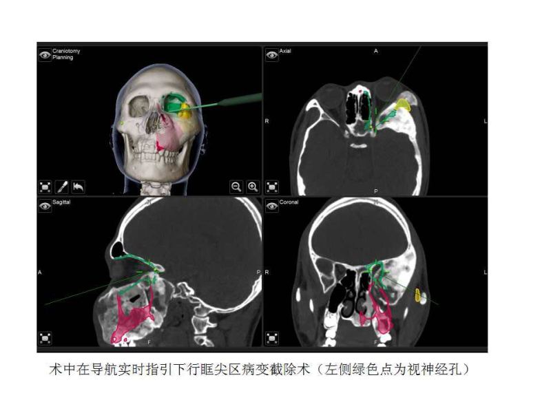 重庆首例3D打印+导航技术的手术顺利完成 20岁怪脸小伙变正常