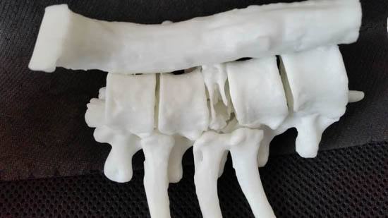武进医院运用3D打印技术 让复杂手术实现个性化治疗