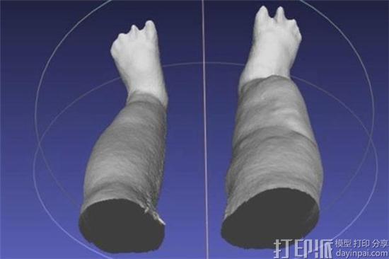 iPad 3D扫描仪帮助华盛顿大学科学家测量象皮病患者的腿肿胀