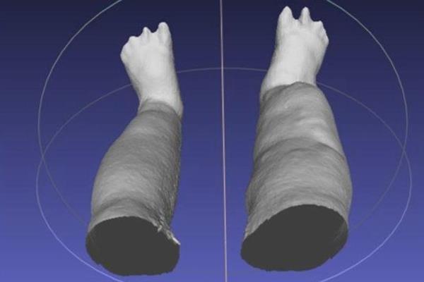 iPad 3D扫描仪帮助华盛顿大学科学家测量象皮病患者的腿肿胀