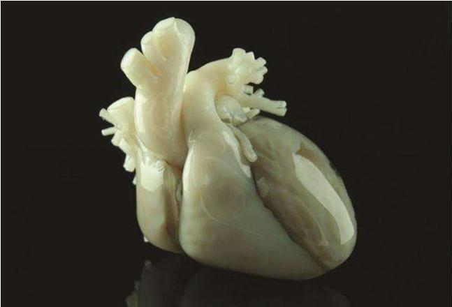 3D打印助力医生诊治复杂性先天性心脏畸形患者