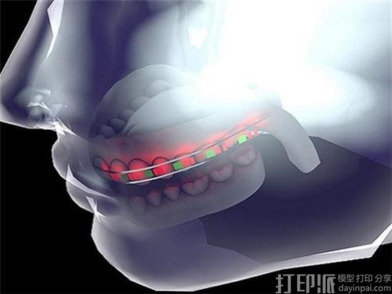 沙特研究人员开发出嵌入LED灯和无毒电池的智能3D打印牙套