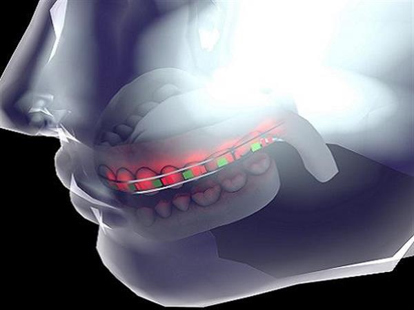 沙特研究人员开发出嵌入LED灯和无毒电池的智能3D打印牙套