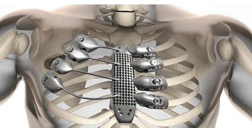 天津医院成功3D打印胸骨柄  让患者“挺起胸膛”