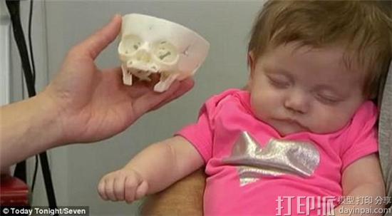 澳洲医生借3D打印颅骨模型成功为鼻腔阻塞的初生儿完成手术 澳洲医生借3D打印颅骨模型成功为鼻腔阻塞的初生儿完成手术