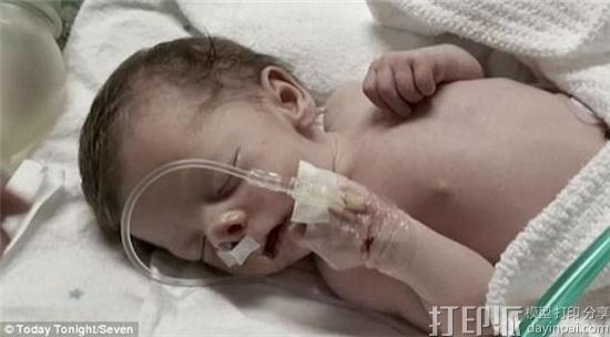 澳洲医生借3D打印颅骨模型成功为鼻腔阻塞的初生儿完成手术 澳洲医生借3D打印颅骨模型成功为鼻腔阻塞的初生儿完成手术